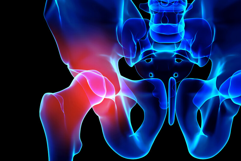 Snapping Hip - OrthoInfo - AAOS